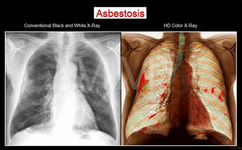 Penyakit Asbestosis