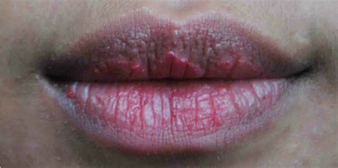Penyebab Bibir Hitam