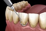 Periodontal Cleaning