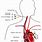 Pulmonary Artery Catheter