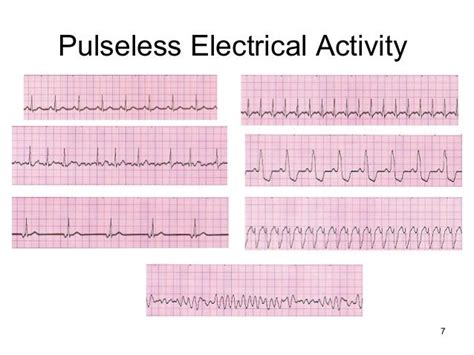 Electrical Activity EKG Strip