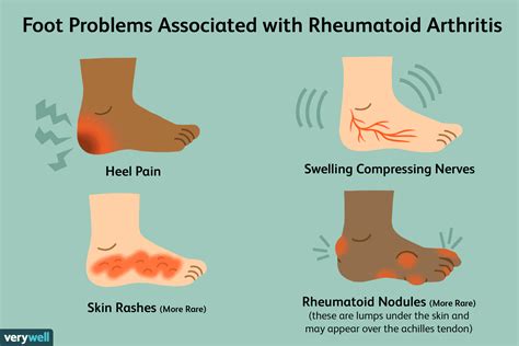 Foot Pain Symptoms