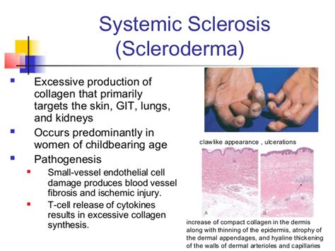 Scleroderma vs