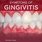 Signs of Gingivitis