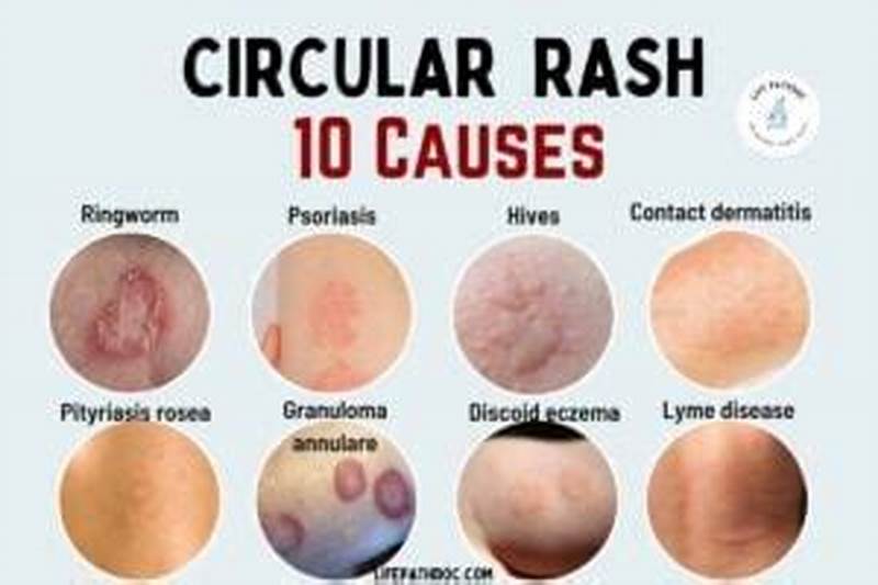 Small Red Bumps In Circular Pattern