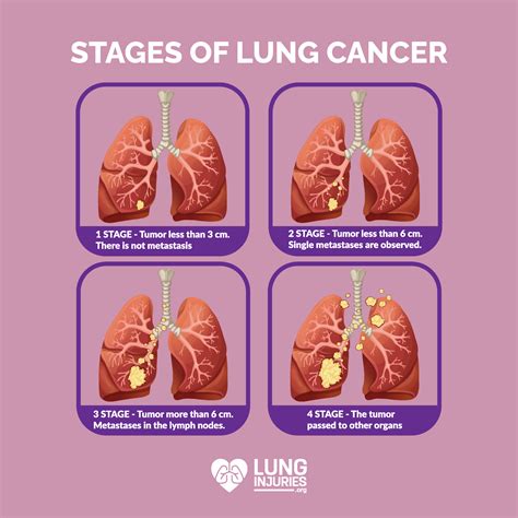 Stages Lung