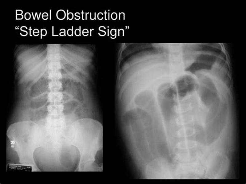 Step Ladder Pattern Small Bowel Obstruction