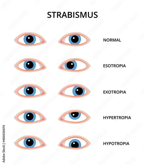 Strabismus Chart