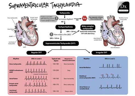 Tachycardia vs AFib