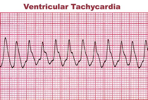 Tachycardia Arrhythmia
