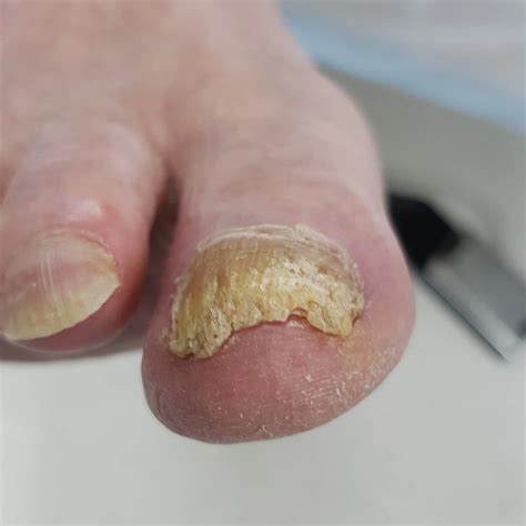 Toenails