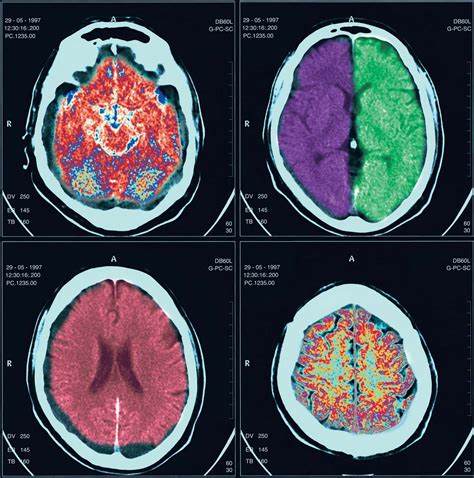 Imaging Brain