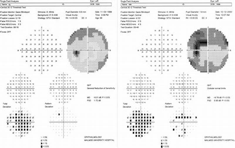 Total Deviation Vs Pattern Deviation Visual Field