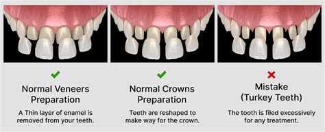 Turkey Teeth Colour Chart