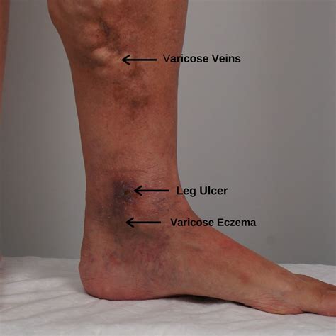 Veins Ulcer