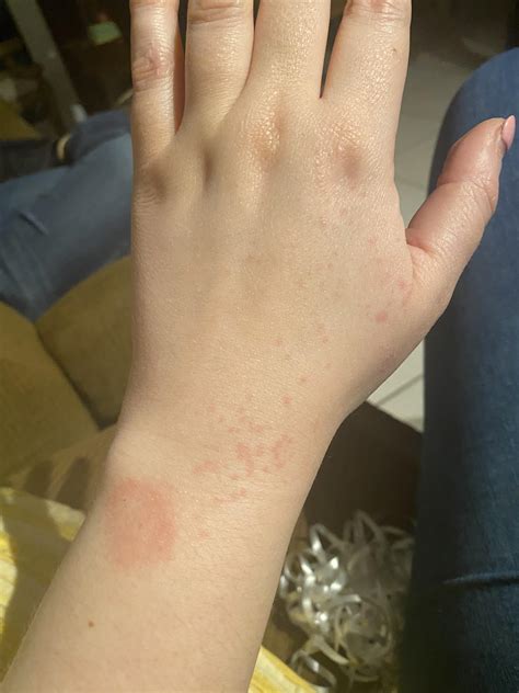 Watch for Allergic Reactions