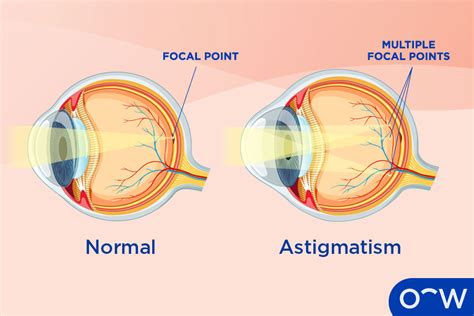 What Cause Astigmatism In The Eye