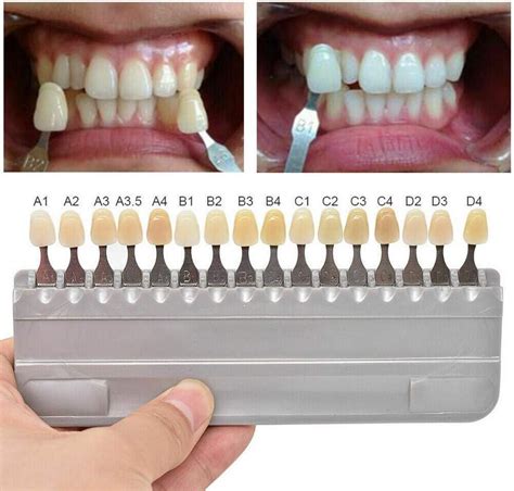 White Teeth Color Chart