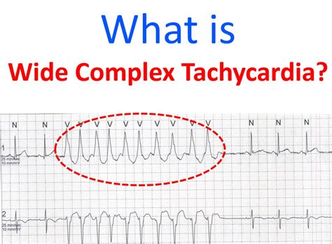 QRS Tachycardia