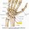 Wrist Fracture Scaphoid Bone