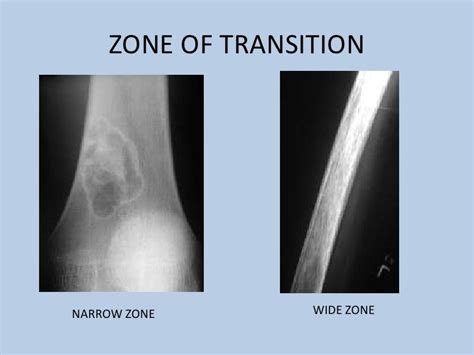 Zone Transition