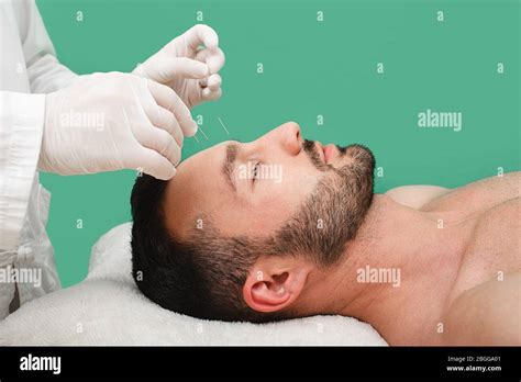 acupuncture