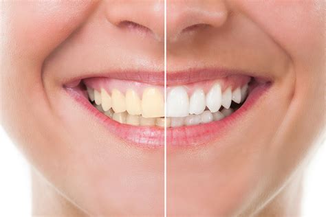 are some teeth unable to be whitened