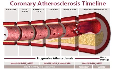 Average Artery Blockage By Age Chart
