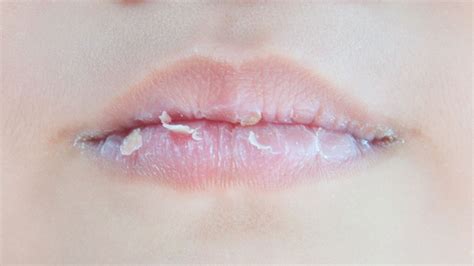 bibir pecah-pecah