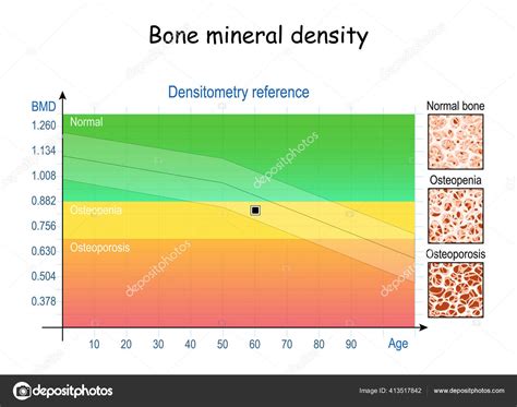 Bone Mineral Density Chart