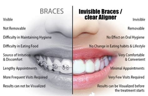 Braces and Invisalign types