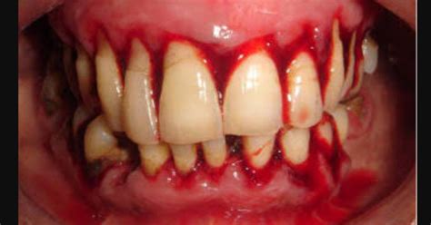 cara mengatasi gigi berdarah terus menerus