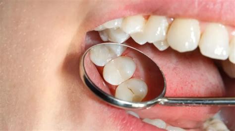 cara mengatasi gigi geraham yang berlubang parah