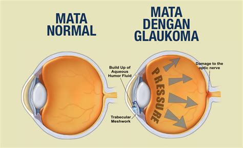 cara mengatasi glaukoma