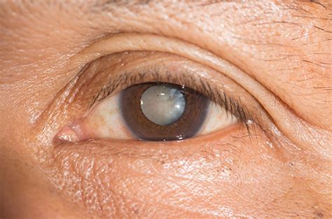 cara mengatasi glaukoma secara alami