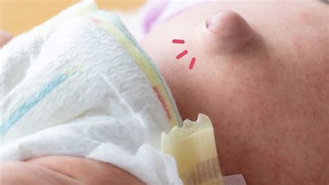 cara mengatasi hernia umbilikalis pada bayi