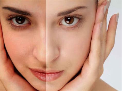 cara mengatasi kulit belang di wajah secara alami
