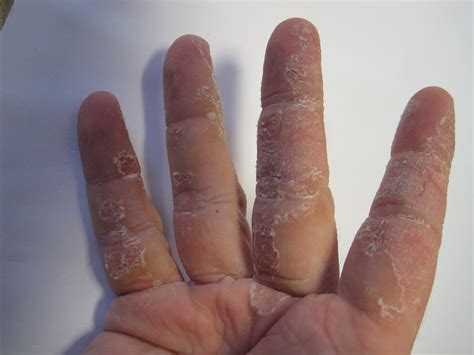 cara mengatasi kulit tangan keriput