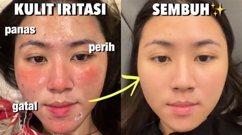 cara mengatasi kulit wajah yang tipis akibat kosmetik
