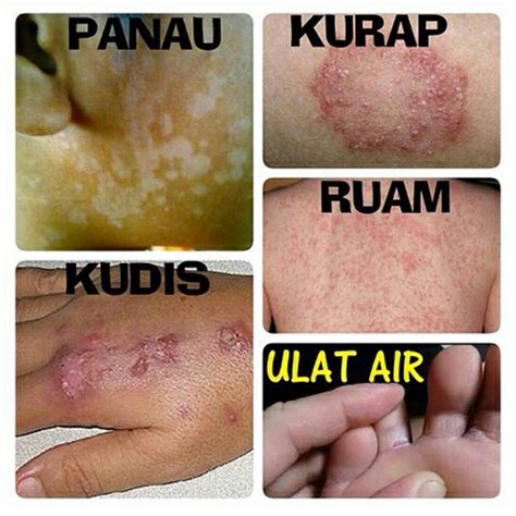 cara mengatasi penyakit kulit