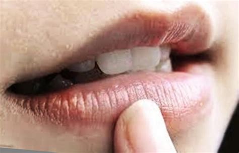 cara mengatasi sudut bibir menghitam