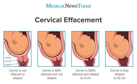 Cervical Effacement Chart
