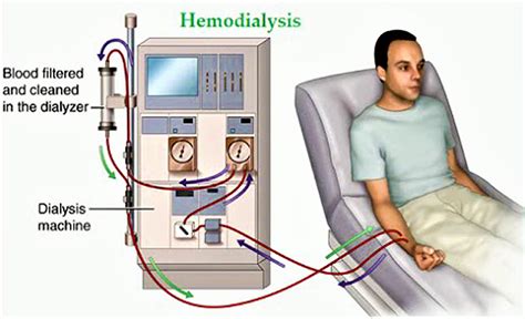 Diagram Hemodialisis