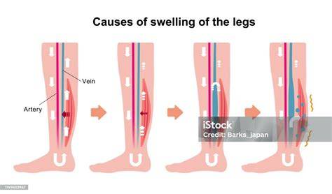 Edema pada kaki
