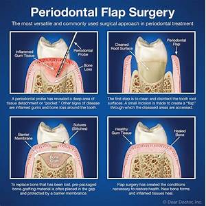 flap surgery for periodontitis