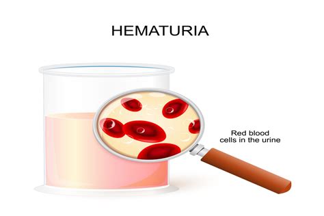 Hematuria