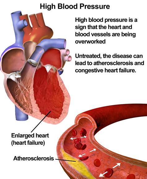increased risk of high blood pressure from excessive alcohol consumption