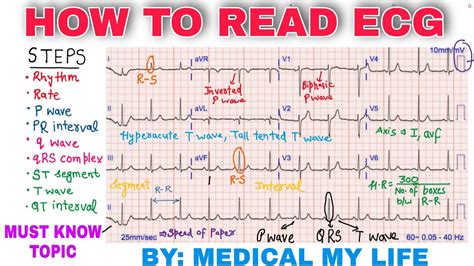 How To Read Ecg Chart