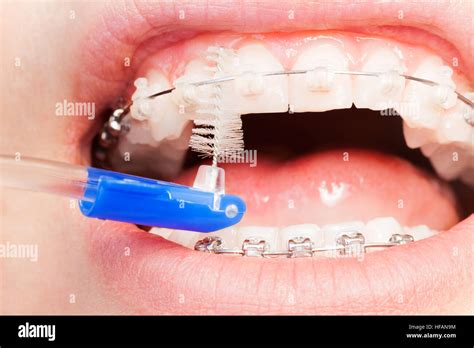 interdental brushes for braces