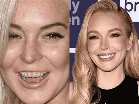 lindsay lohan new teeth 2024